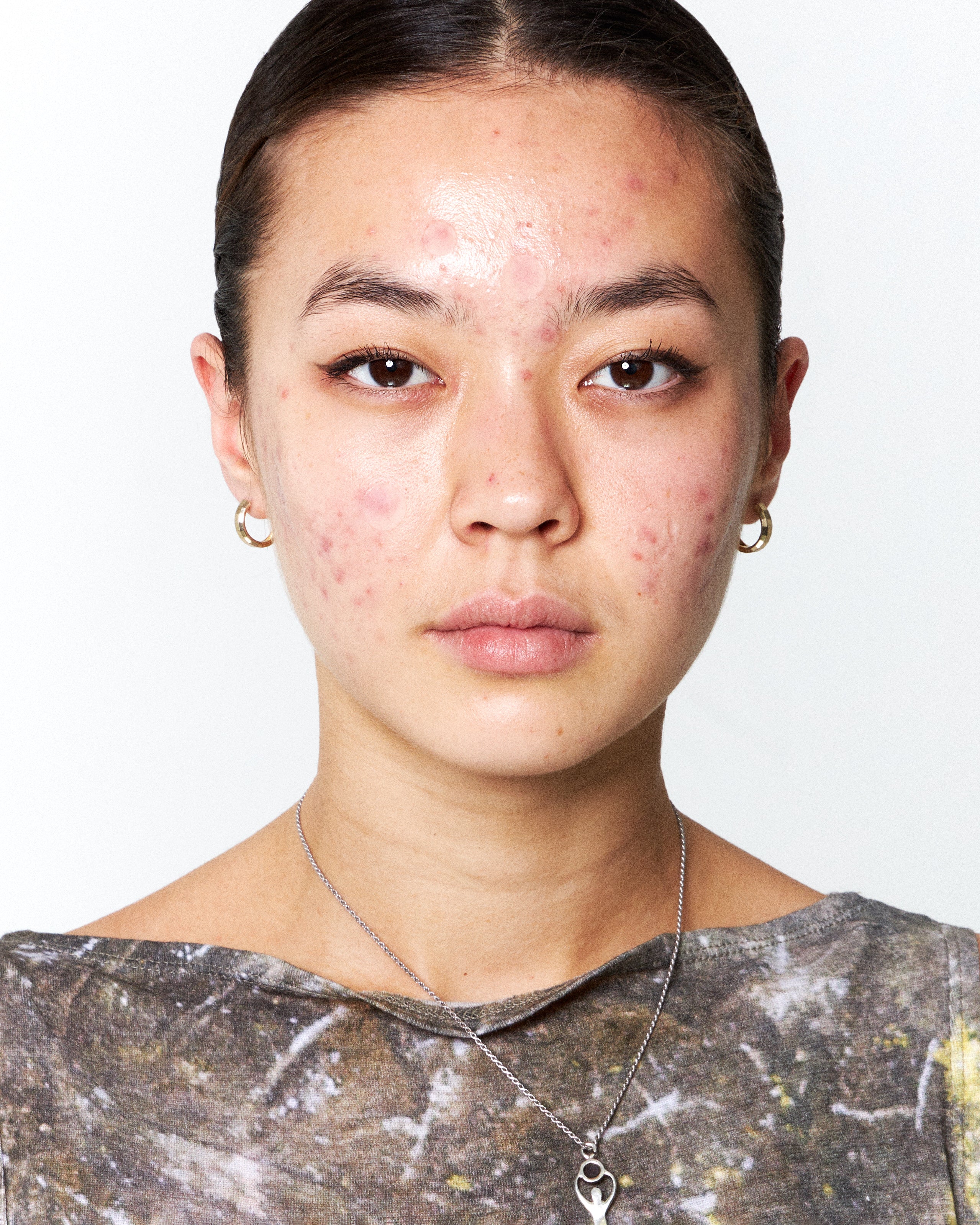 HOW DO I KNOW I HAVE HORMONAL ACNE? HOW TO GET RID OF HORMONAL ACNE AND IMBALANCE