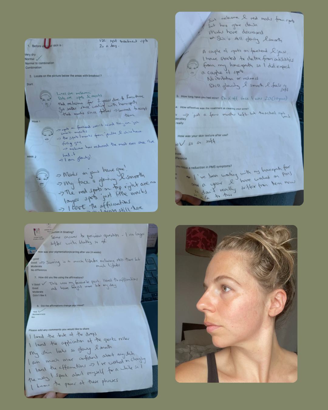 HOT GIRLS HAVE ACNE: THE HEALING STORIES